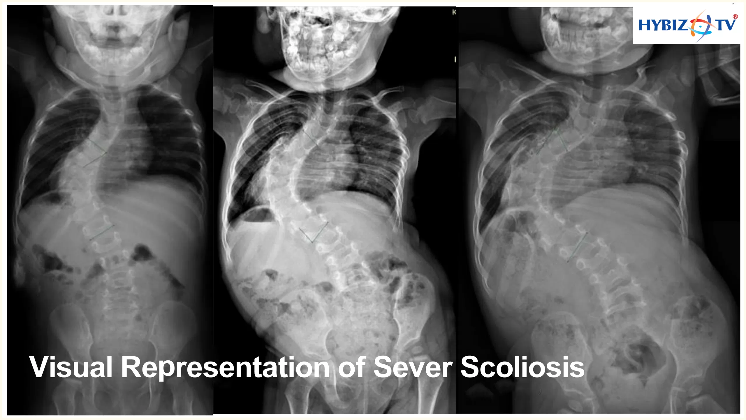Severe Scoliosis at Arete Hospitals